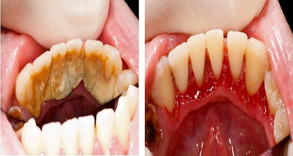 severe calculus buildup in mouth