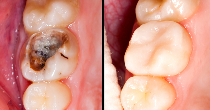 Scientists Have Found A Drug That Regenerates Teeth, And It Could Leave ...