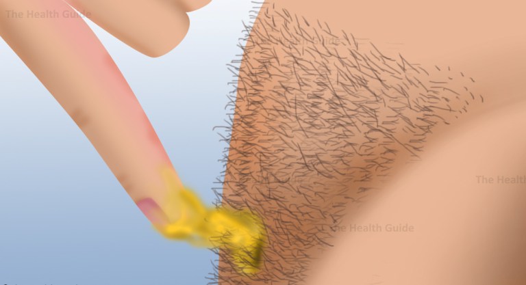 Impressive This Is How You Can Remove Body Hair Permanently No