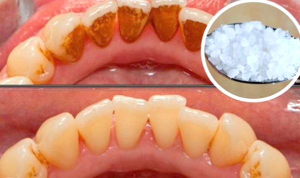 This Can Even Whiten EXTREMELY Yellow Teeth And Remove ...